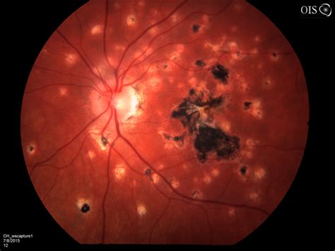 Restoring Hope: An Optometrist's Guide to Diagnosing Ocular Histoplasmosis for Low Vision Patients